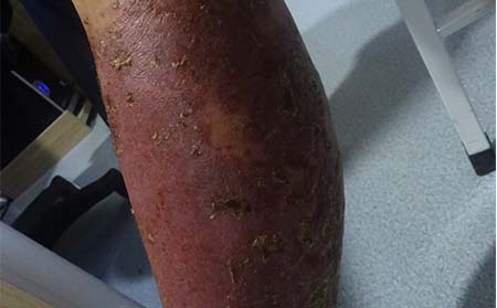 紅皮型銀屑病,紅皮型銀屑病初期癥狀表現