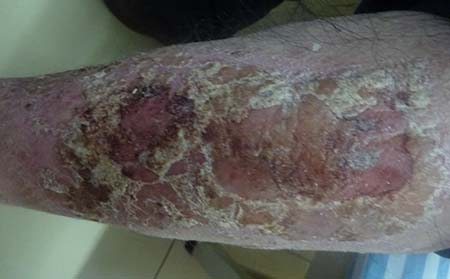 腿部銀屑病,腿部銀屑病癥狀