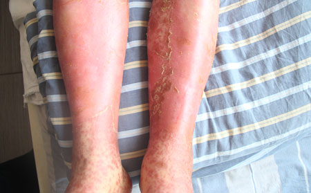 早期紅皮病型銀屑病癥狀