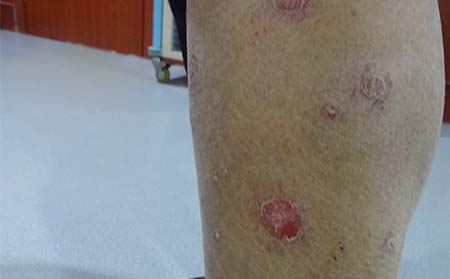 點(diǎn)滴狀牛皮癬,點(diǎn)滴狀牛皮癬癥狀