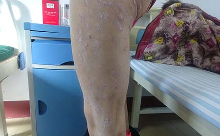 銀屑病表現(xiàn),銀屑病表現(xiàn)癥狀