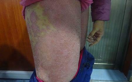 牛皮癬紅斑鱗屑表現