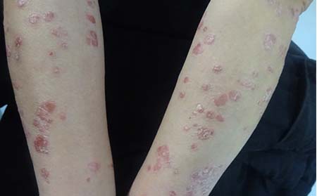 初期兒童牛皮癬癥狀