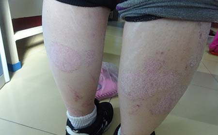 腿部牛皮癬有什么癥狀