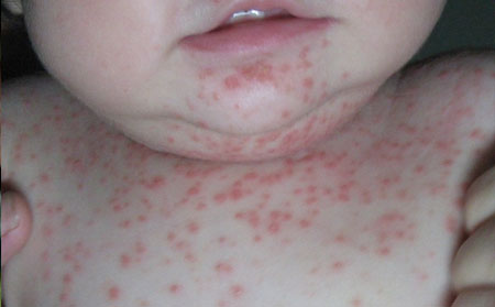 兒童尋常型銀屑病癥狀