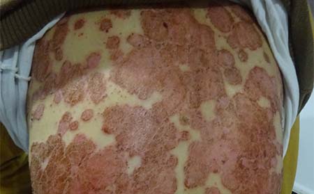 紅皮型銀屑病癥狀,紅皮型銀屑病好轉癥狀