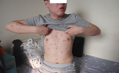 濰坊牛皮癬專科醫院好效果