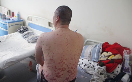 濰坊牛皮癬怎么治