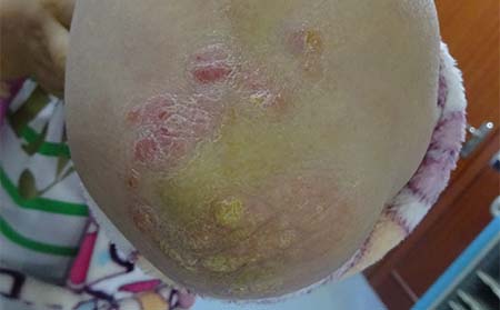 濰坊銀屑病醫(yī)院治療費用