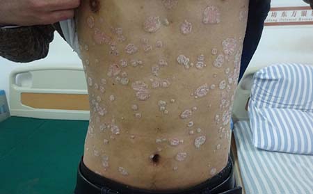 濰坊牛皮癬醫院的治療費用