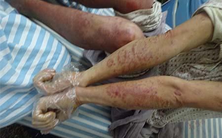 濰坊治療牛皮癬的醫院