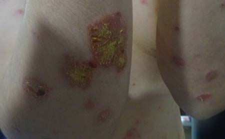 濰坊做銀屑病檢測的醫院