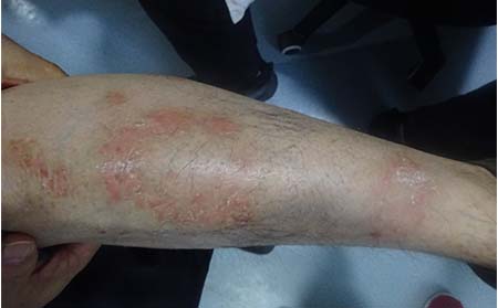 濰坊中醫(yī)治療銀屑病去哪里好呢