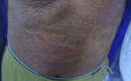 牛皮癬和銀屑病有什么區別