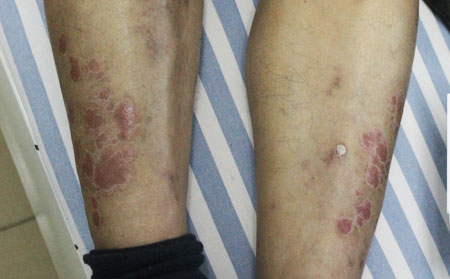 濰坊看牛皮癬去哪家醫院比較好