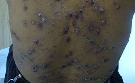 銀屑病需要檢查的項目