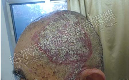 銀屑病護理方法