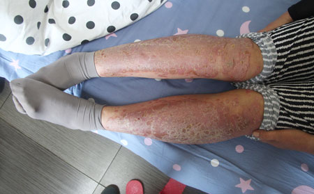 濰坊好的銀康銀屑病醫(yī)院