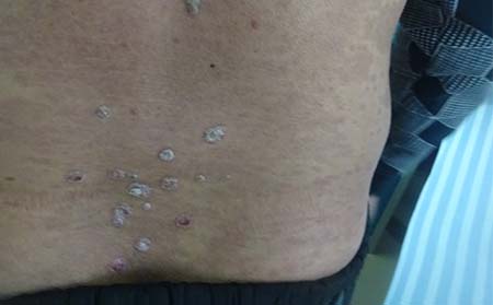 濰坊哪所醫院看診銀屑病好