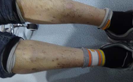 男性銀屑病癥狀,男性銀屑病癥狀表現