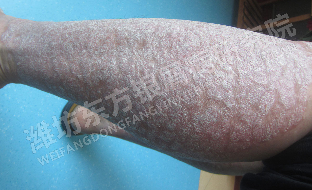 男性銀屑病的治療