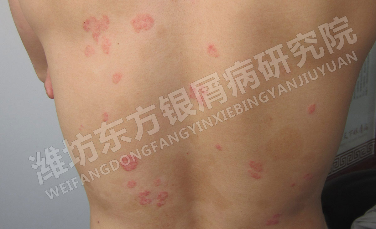 銀屑病的日常護理