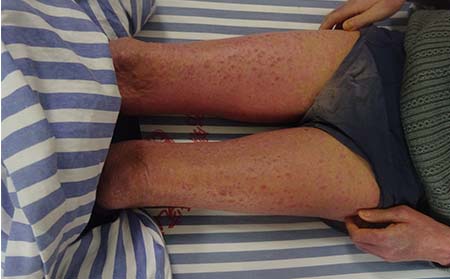 腿部銀屑病癥狀,腿部銀屑病癥狀表現