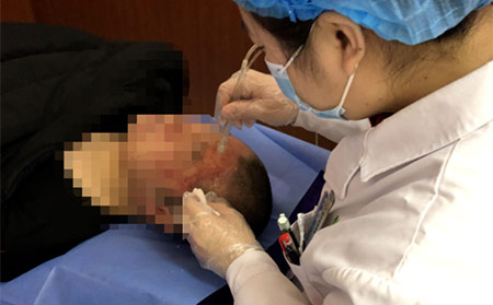 銀屑病發(fā)展階段