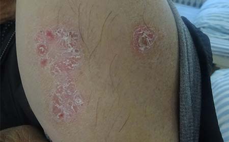 男性銀屑病癥狀,男性銀屑病癥狀圖片