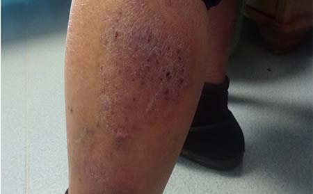 牛皮癬擴散癥狀表現,牛皮癬擴散什么樣