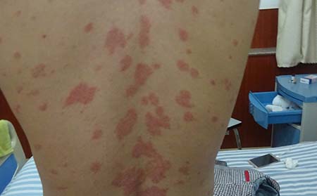 兒童牛皮癬癥狀,兒童牛皮癬癥狀表現