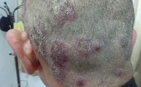 牛皮癬癥狀特點,牛皮癬癥狀表現