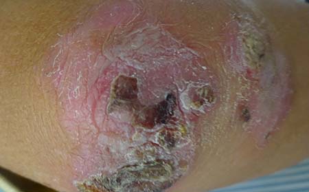 膿皰型銀屑病癥狀,膿皰型銀屑病表現