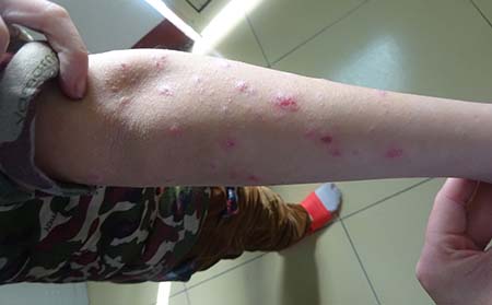夏季牛皮癬預防,夏季胳膊上有牛皮癬