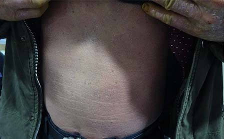 尋常型銀屑病癥狀,尋常型銀屑病圖片