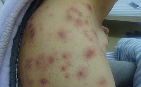 銀屑病癥狀,銀屑病發病癥狀表現