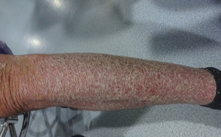 如何護理牛皮癬,牛皮癬生活護理方法