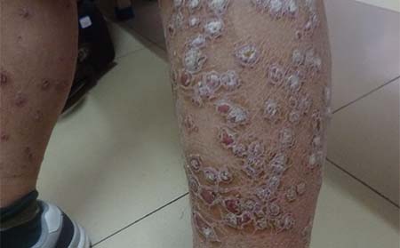 牛皮癬飲食,牛皮癬吃什么,牛皮癬排毒