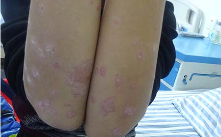 女性牛皮癬癥狀,女性牛皮癬癥狀表現(xiàn)