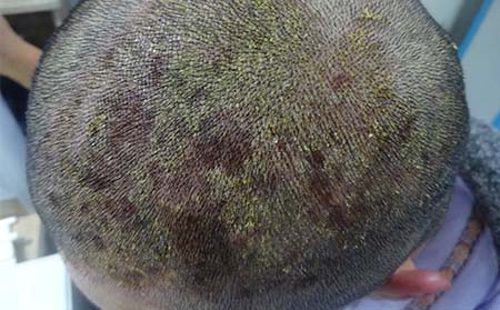 頭皮銀屑病癥狀,頭皮銀屑病圖片表現