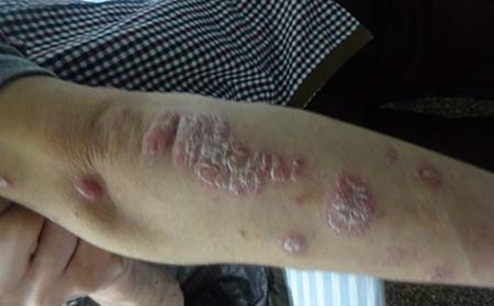 牛皮癬治療,牛皮癬好治么