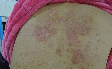 牛皮癬初期癥狀,初期牛皮癬發病癥狀