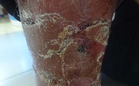 銀屑病癥狀,銀屑病晚期癥狀表現(xiàn)