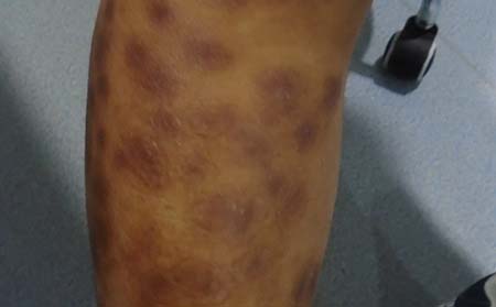 牛皮癬癥狀,牛皮癬嚴(yán)重癥狀表現(xiàn)