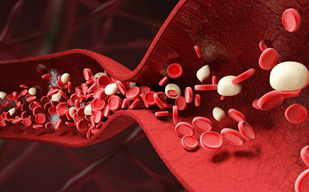 關節(jié)型銀屑病護理,怎樣護理關節(jié)型銀屑病