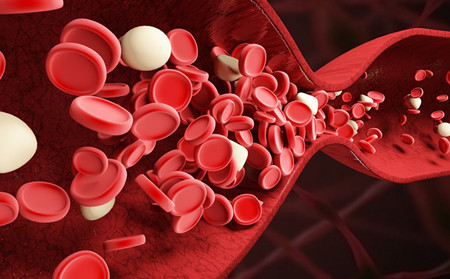 夏季牛皮癬禁忌,夏季牛皮癬生活注意