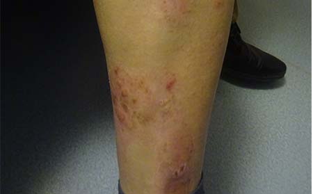 女性銀屑病癥狀,女性銀屑病癥狀特征