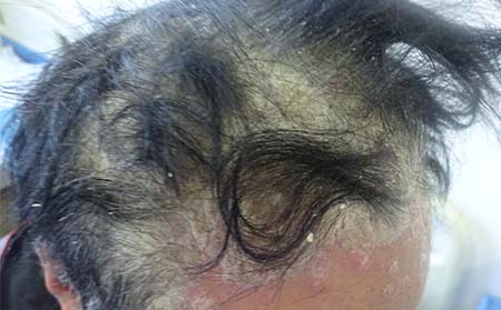 老人銀屑病癥狀,老年銀屑病癥狀