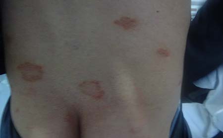 青少年銀屑病癥狀,青少年銀屑病什么樣