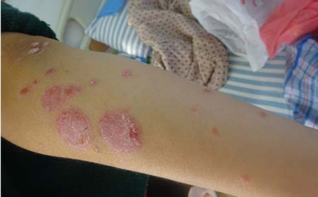 胳膊牛皮癬癥狀,胳膊長牛皮癬什么樣